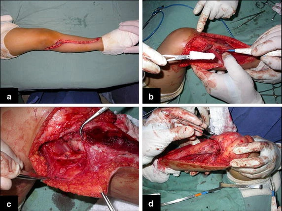 Figure 2: a Single incision, b opening of the perimysium and lateralization of the anterior tibial muscle, c dissection of the proximal part of the fibula and d dissection of tibial epiphysis