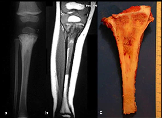 Figure 1: a Radiography of the tibia showing a proximal metaphyseal bone tumor. b MRI image showing no compromise of the proximal epiphysis by the tumor. c Resected specimen