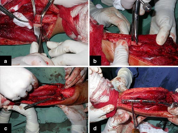 Figure 4: a Small periosteal removal from the fibula, b nailing the fibula in the medullary canal of the tibia, c repositioning of the fibula under the center of the tibial plateau and reinsertion of the lateral ligament and d proximal and distal osteosynthesis with screws