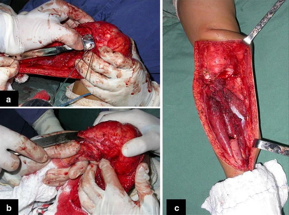 Figure 3: a Introduction of a wire-guide in the epiphysis and checking the position for the plate. b Separation of the tibial epiphysis from the tumor by transepiphyseal osteotomy and c tumor resected