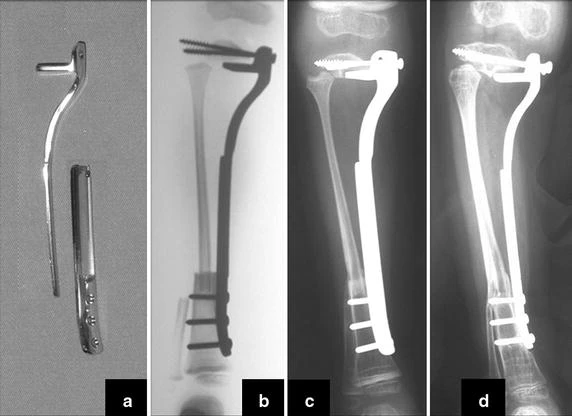 Figure 9: a The proximal-plate with a horizontal support, for proximal tibia epiphisial support, b immediate postoperative radiograph, c 3 months postoperative radiograph, showing the distal tibio-fibular consolidation and d 6 months postoperative radiograph, showing hypertrophy the fibula