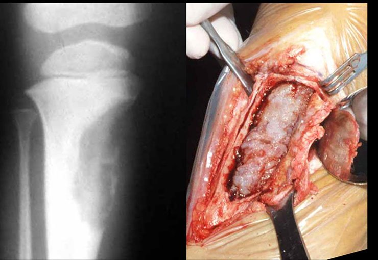 Fibroma Condromixóide