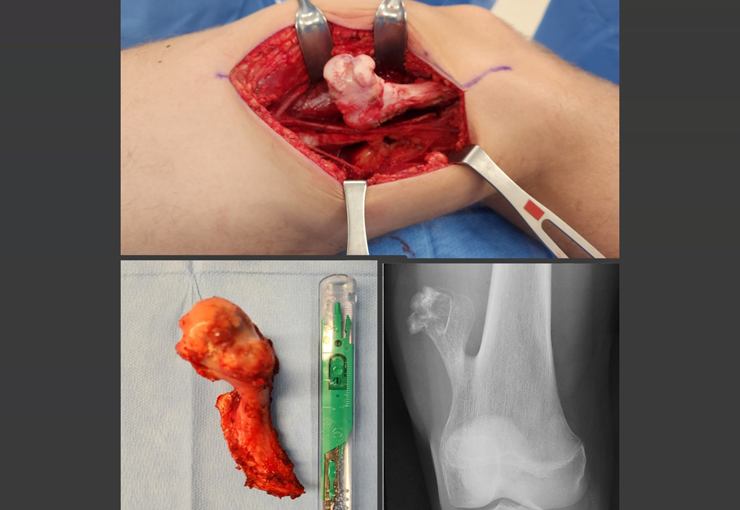 Osteocondroma