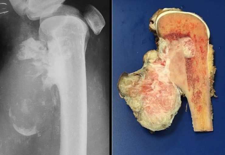 Osteossarcoma de Superfície