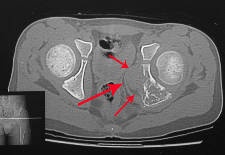 Sarcoma de Ewing Diagnóstico e Tratamento