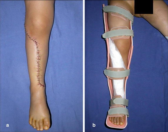 Figure 6: a Surgical wound and b custom made orthesis