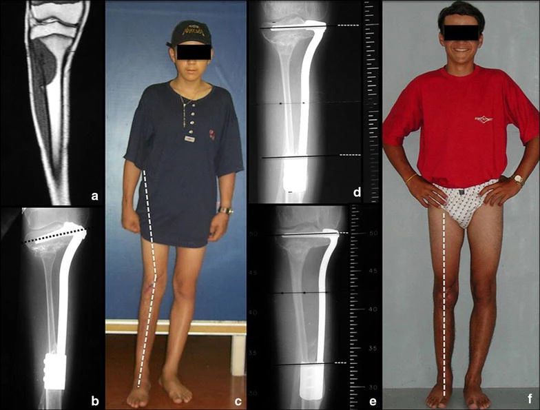 Figure 7: a Preoperative magnetic resonance, b 4 months postoperative radiograph showing the slope of the tibial epiphysis screws, c patient at 4 months after surgery with valgus knee deviation, d patient at 1 year and 2 months after surgery, with fixed valgus deformity and e 1 year and 2 months postoperative radiograph showing fibula hypertrophy, screws tilt correction and growth of 0.75 cm and f radiography postoperative 2 years and 2 months with growth of 1.2 cm