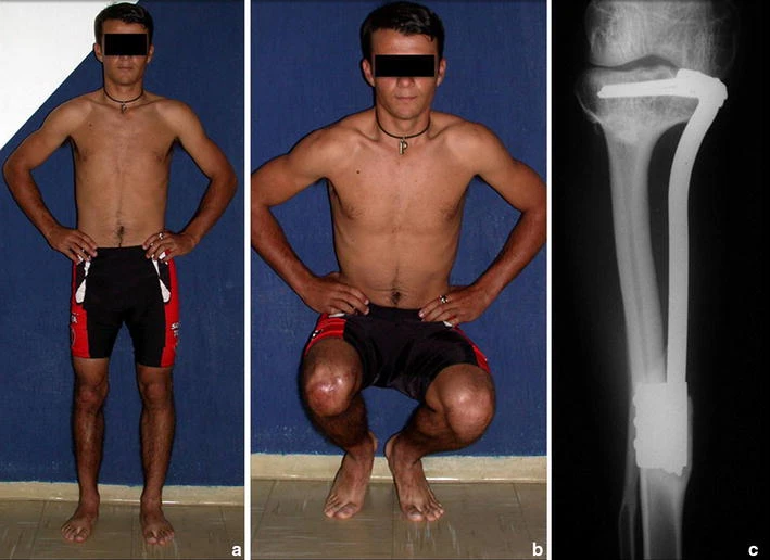 Figure 8: a patient 3 years and 7 months postoperatively, at full load, b 3 years, 7 months, bending under load and good function of the knee, and c radiograph 3 years, 7 months, fibula hypertrophied, already fully tibializated