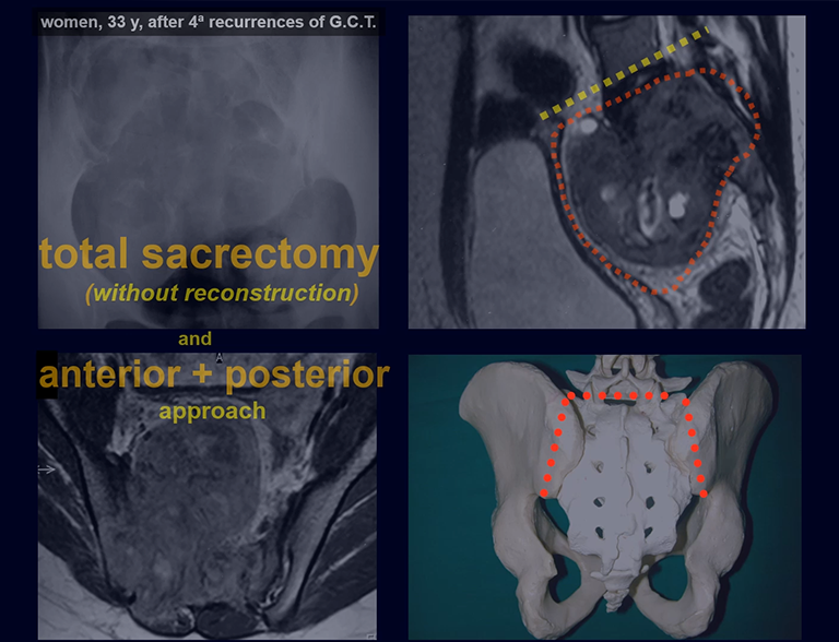 Total sacrectomy