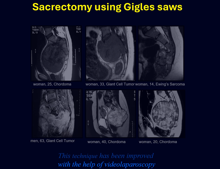 Total sacrectomy technique using Gigli saws Part II