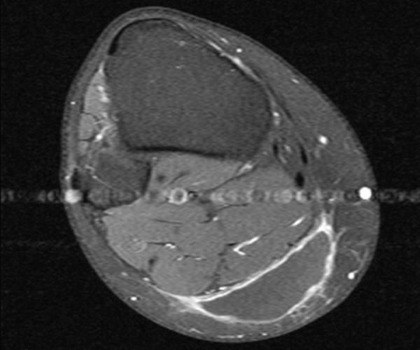 Figura 15: Ressonância magnética atual evidenciando imagem axial ponderada em T1 contrastada e com supressão de gordura. Vemos lesão de baixo sinal com realce periférico do contraste, bem delimitado e homogeneamente de baixo sinal no interior da lesão. A lesão esta dissecando o plano entre o tecido celular subcutâneo e a fascia muscular